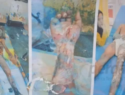 Bantu Doni, Warga Perdagangan 1 Seberang Terancam Amputasi Kedua Tangan Akibat Sengatan Listrik